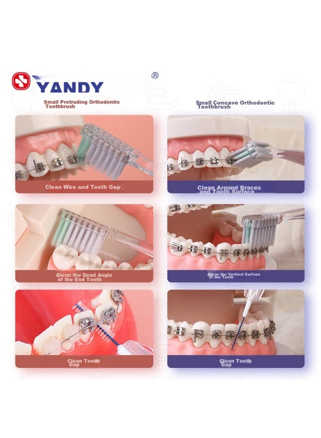 Yandy Orthodontic Toothbrush, Concave U-shaped, 3-pack, For Adults And Children With Braces, Soft Bristles, Small Head - Image 3