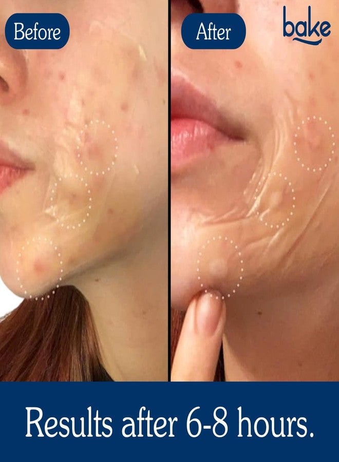 BAKE 2% Salicylic Acid Hydrocolloid Acne Absorbing (10 Patches) Surface Patch XL Pimple Patches for Blackheads Removal | Large Acne Erase Strips | Pore Cleansing & Reduces Whiteheads (10 Strips) - Image 4