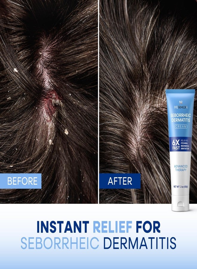 Hermon Seborrheic Dermatitis Scalp Treatment Cream: Soothing Itching Redness Scaling of Seborrheic Dermatitis - Fast-Acting Anti-Itch Ointment for Scalp Face Chest and Body for Men and Women 1 Pack - Image 4