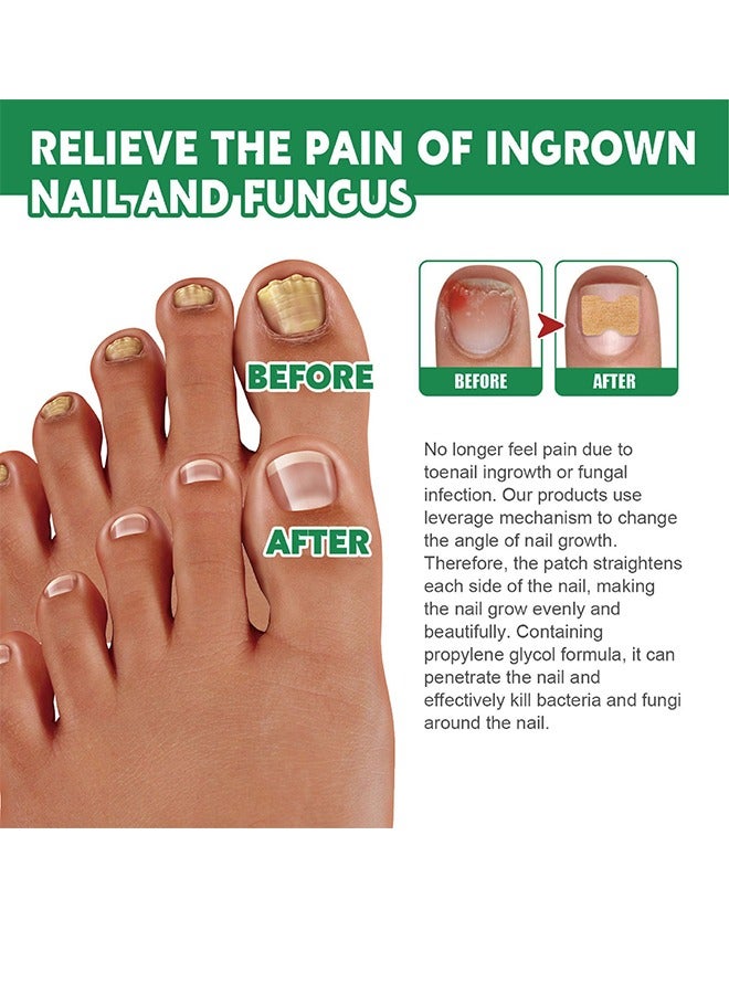 Bupy Nail Repair Patch For Hands And Feet, Soft Ingrown Nails, Thickened Nails, Bright Nails, Nail Grooves, Onychomycosis Care Patch - Image 5