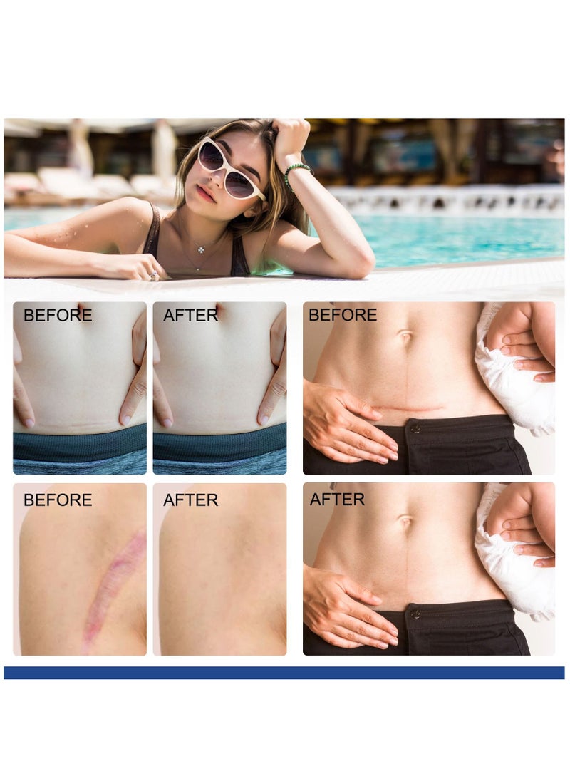 ALIVER - Medical Grade Silicone Scar Sheets Roll 3m Tape Keloid C-Section Surgical Scars Removal Treatment Silicon Gel Cream Patch Bandage Removes Abs Tuck Surgery Scars (4cm x 3m) - Image 1