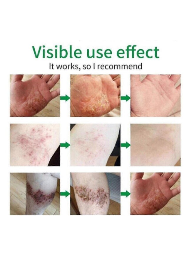 Sumifun Natural Herbal Psoriasis Cream - 20gm - Image 3