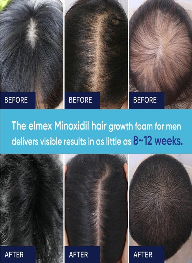 Artimore 5% Minoxidil Foam for Men and Women, 5% Minoxidil for Men Foam, Minoxidil for Women Hair Growth (60) - Image 5
