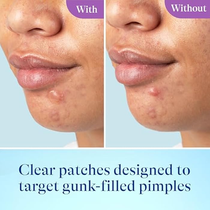 Differin Power Patches for White Head Pimples, Hydrocolloid Patches formulated with Zinc Hyaluronate and Niacinamide, 4-in-1 Hydrotech™ Formula, Helps Absorb Impurities and Restore Skin, 23 ct - Image 5