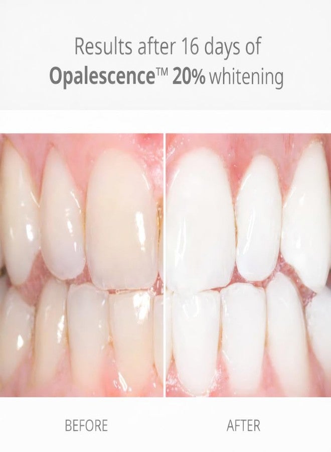 Opalescence 20% with PF Gel Syringes Teeth Whitening (4 Syringes Refill Kit Carbamide Peroxide. Made by Ultradent, in Melon Flavor. Tooth Whitening Refill Syringes 5401-2 - Image 2