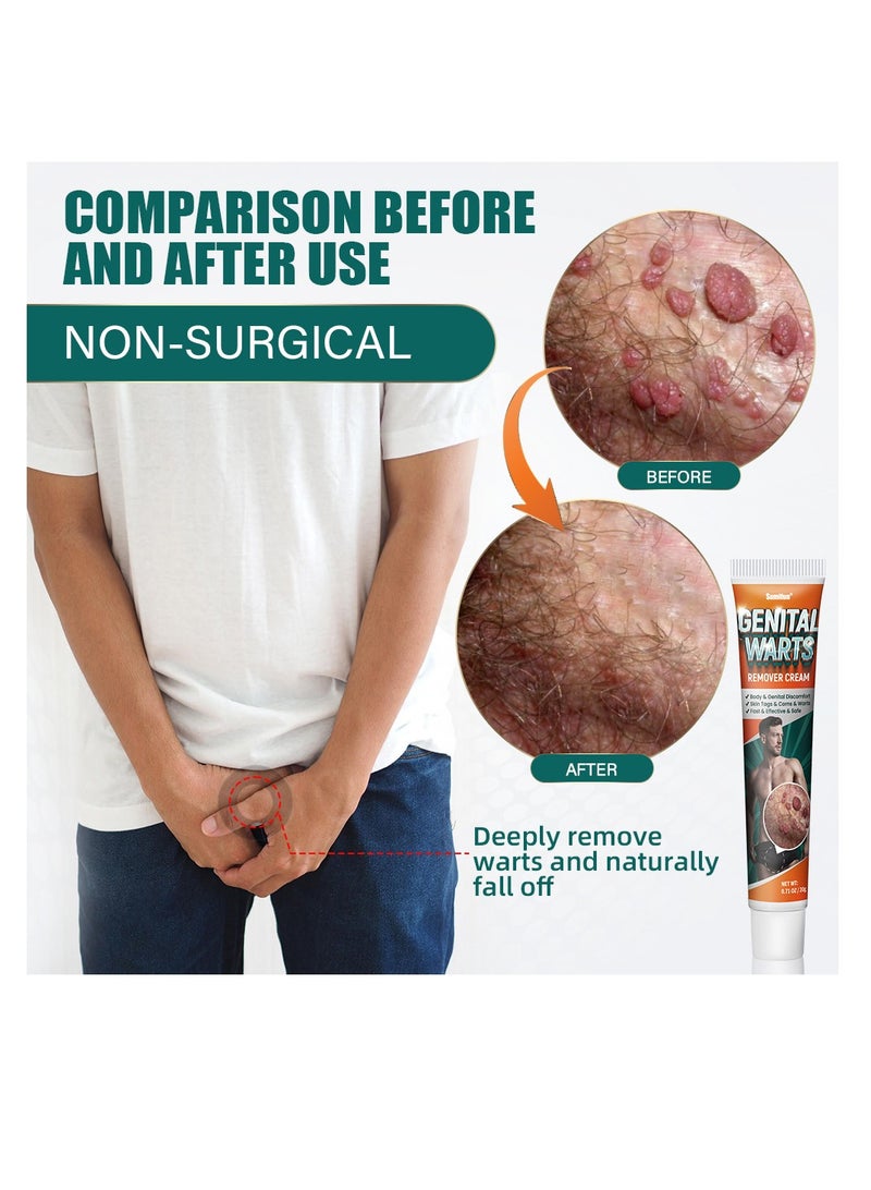 Genital Wart Off, Genital Wart Removal Cream 0.7oz Easy Absorption Soften Cuticle Pointy Condyloma Removing Cream Remove Common Warts, Plantar Warts, Genital Warts
