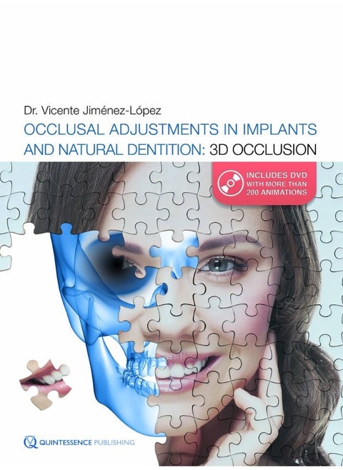 Occlusal Adjustments in Implants and Natural Dentition: 3D Occlusion