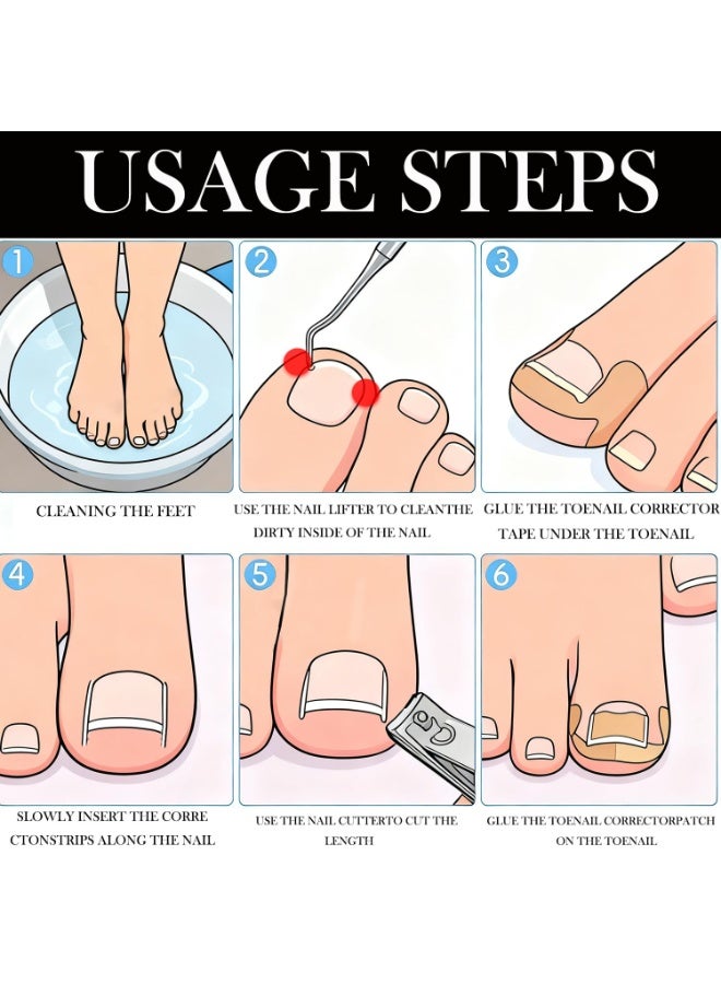 مجموعة تصحيح الأظافر الغائرة مع شرائط تصحيح، طقم أدوات احترافي لعلاج الأظافر الغائرة، رقعة تصحيح الأظافر المنحنية، للعناية المنزلية بالقدمين - Image 2