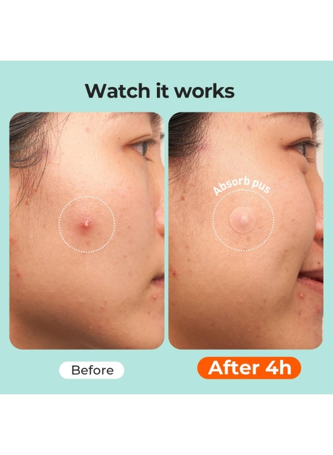 OUHOE 443 Count Pimples Patches in 5 Sizes for Pimples and Clusters of Acne, Hydrocolloid Acne Patch, Acne Stickers for Covering Cheeks, Forehead, Chin Blemishes Zit Breakouts for All Skin Types - Image 3