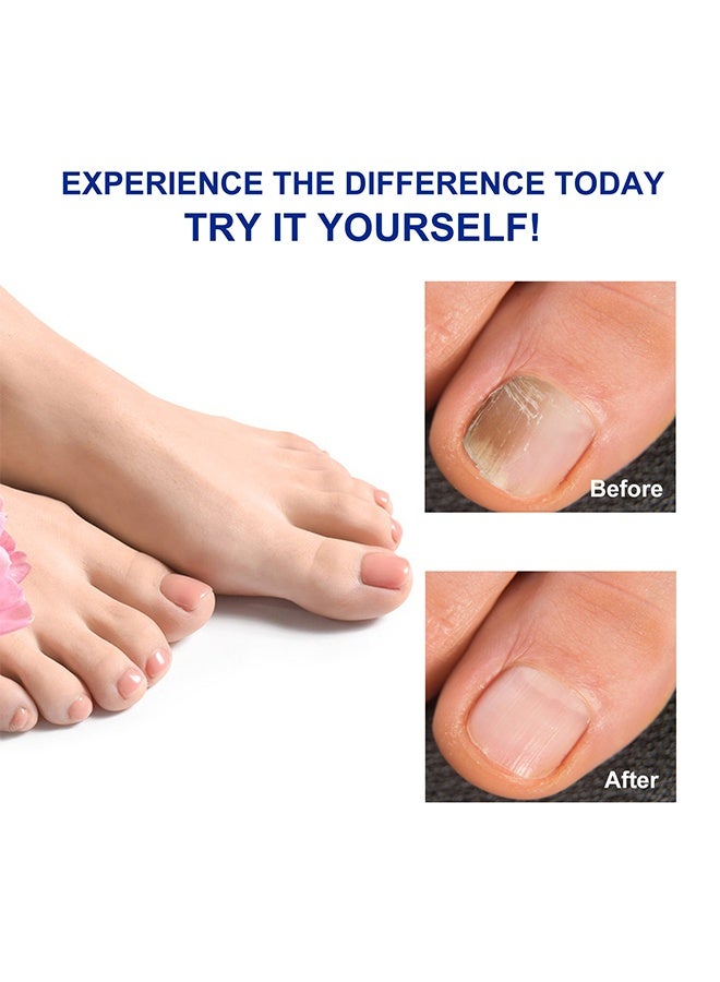 Sefudun 32 Patches Fungal Nail Patches, Overnight Nail Repair Patch, Renews Nails Structure & Improve Discoloration, Soft Nail Thickening Nail Stickers - Image 4