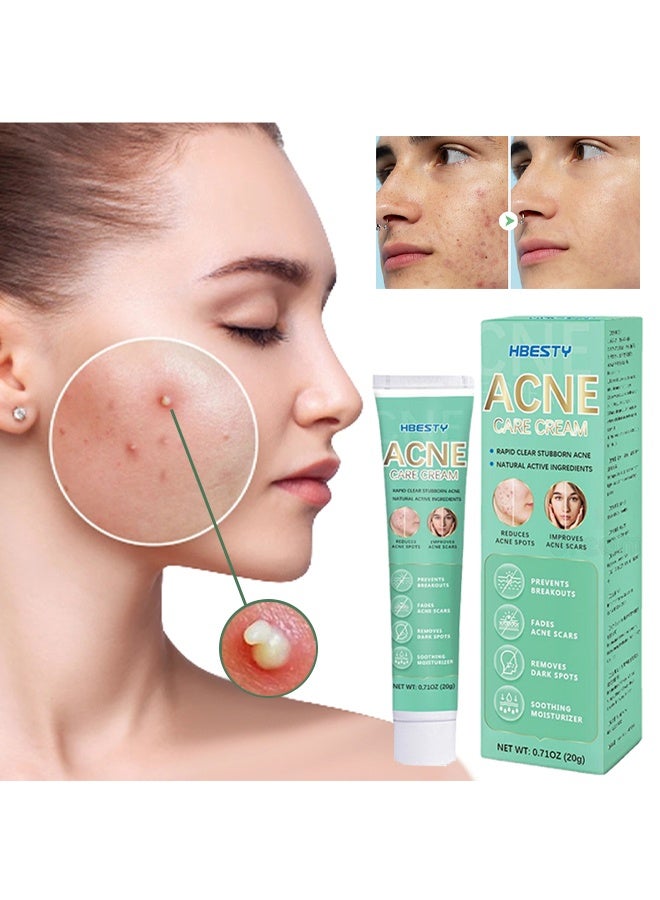 HBESTY Acne Care Cream，Acne Treatment Face Cream，Oil Control Anti Acne Facial Care ，Acne Spot ，Cystic Acne，Fungal Acne ，Face Acne Spot Treatment and Acne Scar Treatment Post Acne Marks Treatment，Pimple Remover， Acne Repair 20g - Image 1