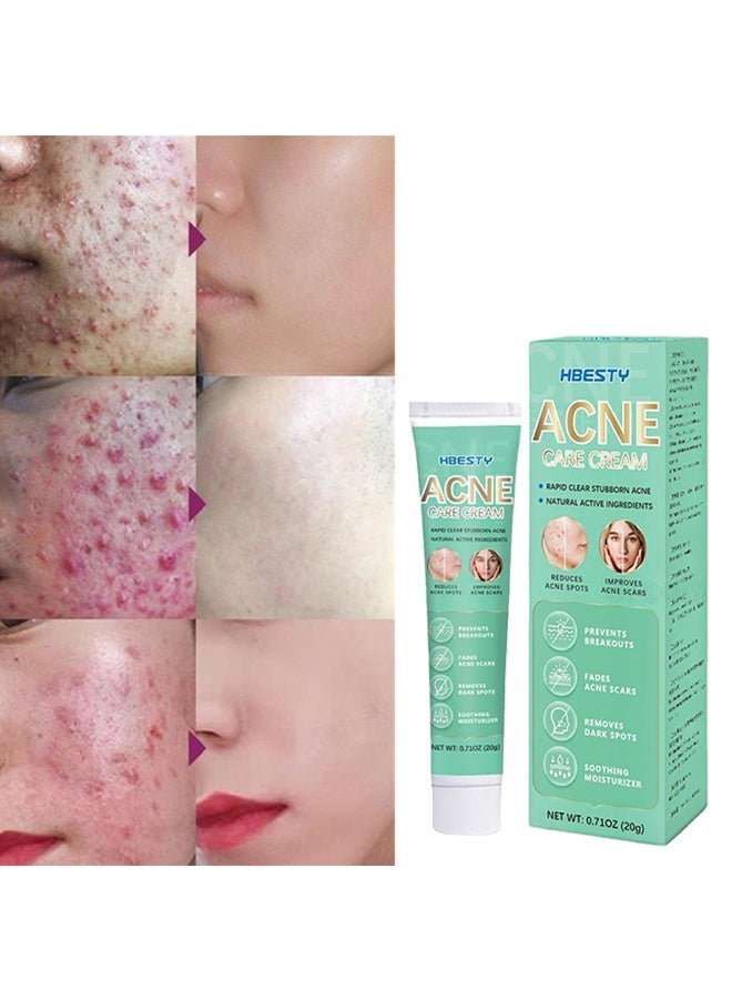 HBESTY Acne Care Cream，Acne Treatment Face Cream，Oil Control Anti Acne Facial Care ，Acne Spot ，Cystic Acne，Fungal Acne ，Face Acne Spot Treatment and Acne Scar Treatment Post Acne Marks Treatment，Pimple Remover， Acne Repair 20g - Image 3