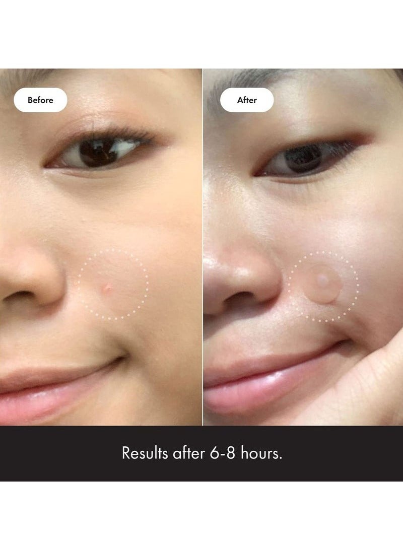 هيرو الأصل hero-cosmetics بقع حب الشباب حب الشباب بقع غرواني مائي لتغطية حب الشباب والعيوب على الوجه والجلد ، نباتي ودية ، لم يتم اختبارها على الحيوانات ( 36 حبة ) - Image 4