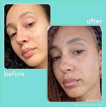 Super Facialist On The Spot Clarifying Gel Spot Treatment for Acne with 10 Niacinamide Tea Tree Oil Prebiotics Vegan Friendly 15ml - Image 3