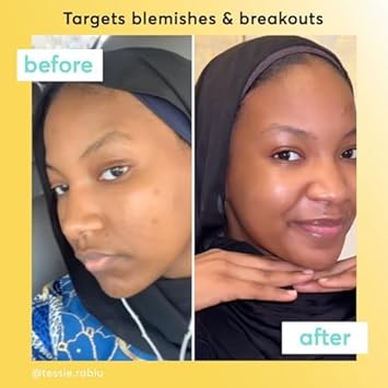 Super Facialist On The Spot Clarifying Gel Spot Treatment for Acne with 10 Niacinamide Tea Tree Oil Prebiotics Vegan Friendly 15ml - Image 5