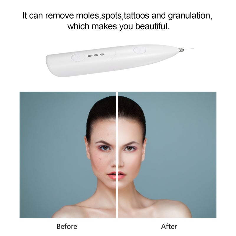 YP30 Mini Freckle Pen USB Charging Beauty Pen Moles Spots Tattoos Remover White - Image 3