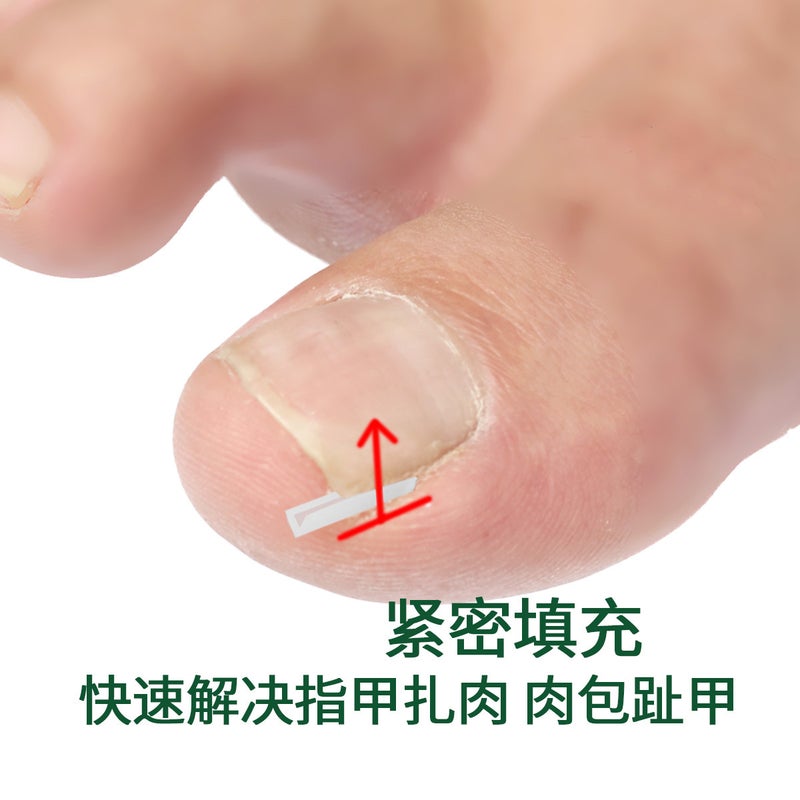Ingrown Toenail Filling Pad Casing Nail Pad C-Shaped Nail Groove Pad Ingrown Toenail Corrector Pedicure Tool Best Selling - Image 3