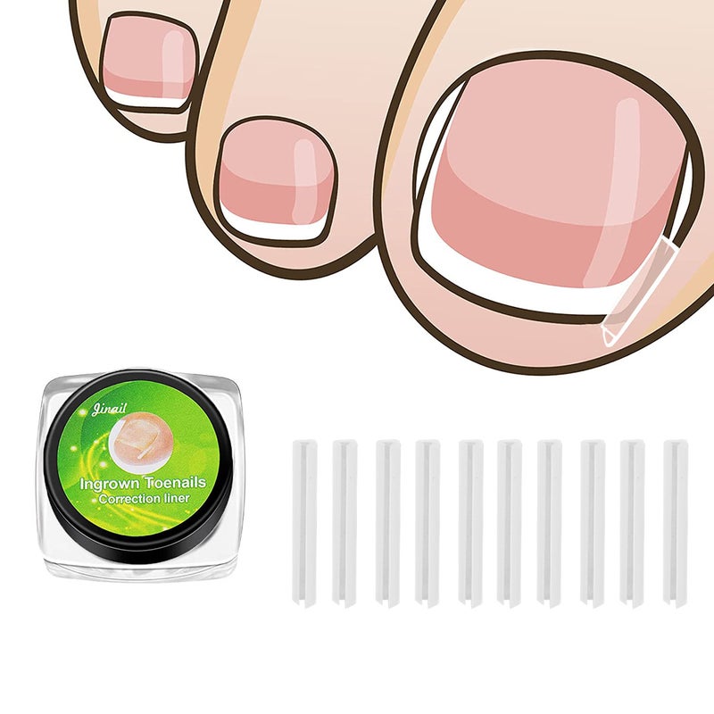 Ingrown Toenail Filling Pad Casing Nail Pad C-Shaped Nail Groove Pad Ingrown Toenail Corrector Pedicure Tool Best Selling - Image 2