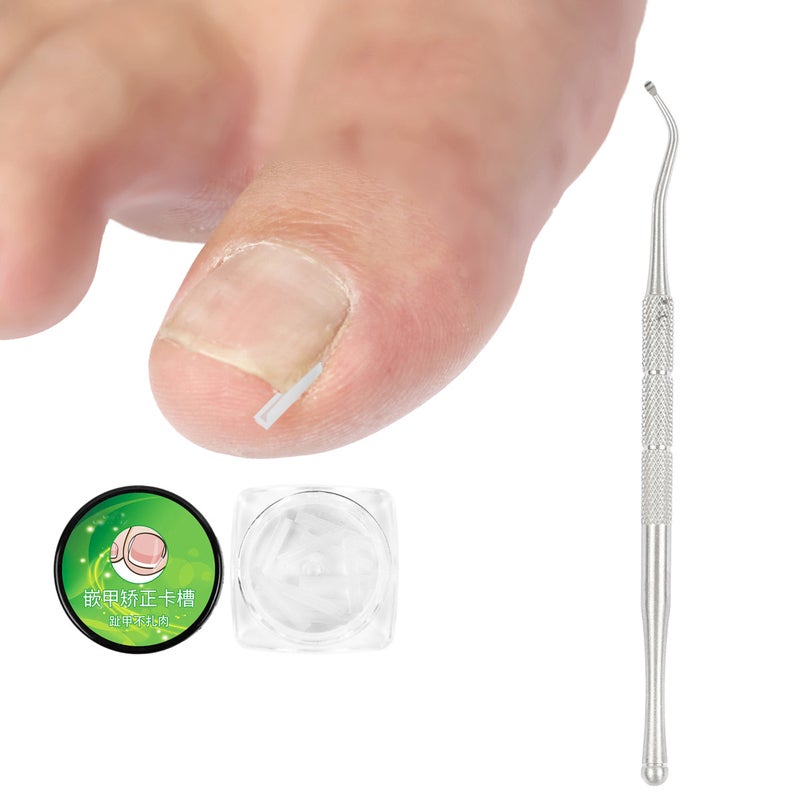 Ingrown Toenail Filling Pad Casing Nail Pad C-Shaped Nail Groove Pad Ingrown Toenail Corrector Pedicure Tool Best Selling - Image 1