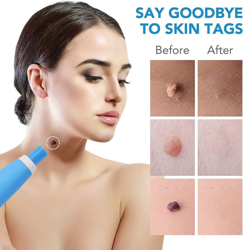 KLIVE Painless Skin Tag Remover Tool Kit with 40 Skin Tag Bands, Wart Removal Kit for Face Neck Fingers Legs, Skin Tag Removal Device for Home Use, Skin Care Tool for Mole Wart and Tag Removal - Image 5