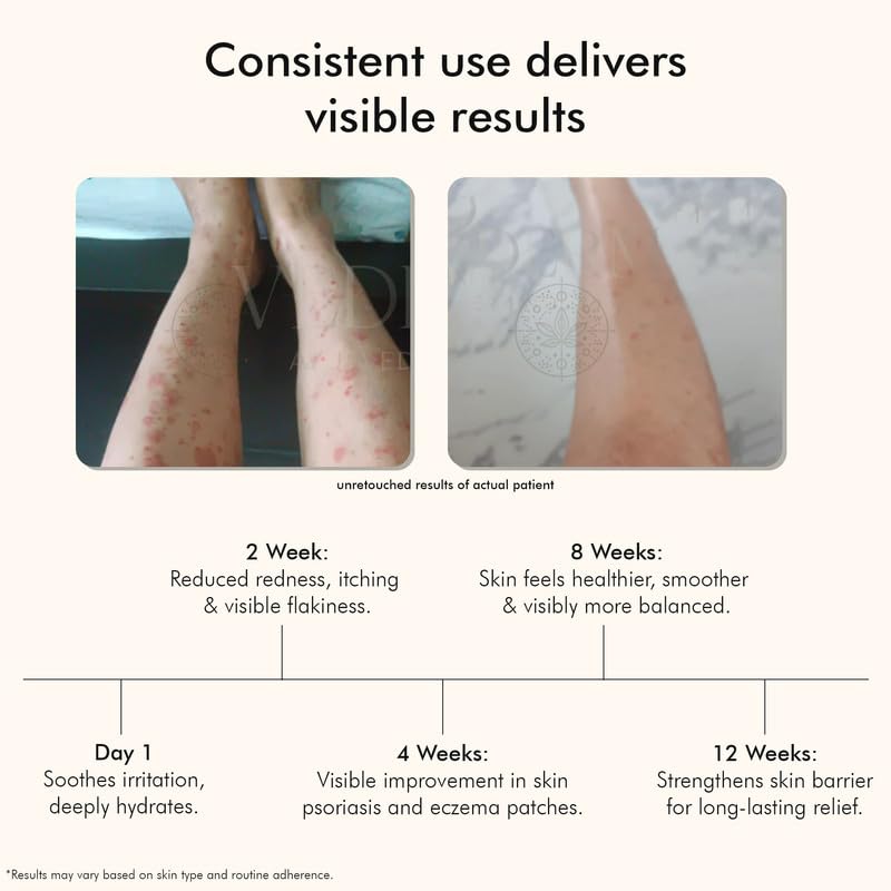 VEDICDERM Natural Psoriasis Cream for Dry Itchy Skin SteroidFree Formula with Ayurvedic Herbs Helps Soothe Redness Flakiness Irritation Moisturizing Body Cream for Sensitive Skin 200ml Pack of 3 - Image 2