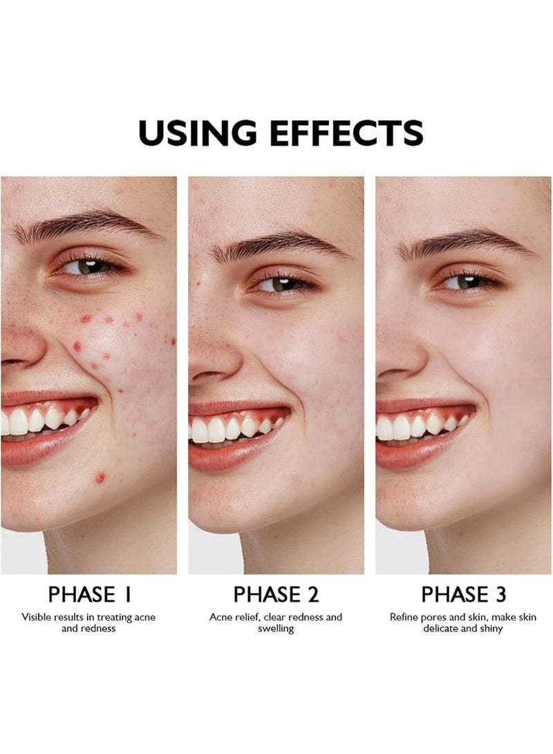 lakerain Azelaic Acid Serum 10% with Licorice Root (30ml), Lightweight Formula for Uneven Skin Tone, Dark Spots, and Acne Marks Refines Skin Texture, Reduces Pimple Breakouts Blackheads, Pigmentation - Image 5