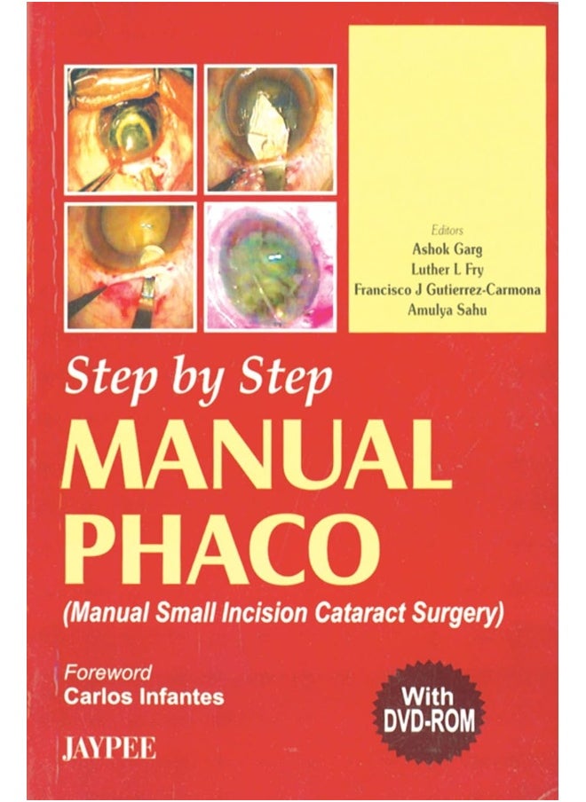 Step by Step Manual Phaco 