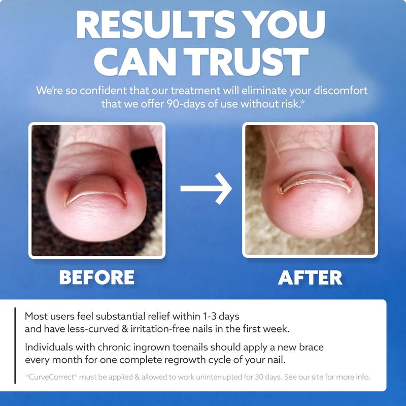 CurveCorrect طقم علاج الأظافر المنغرسة - طقم تصحيح الأظافر المنغرسة مع 10 دعامات - تصحيح الأظافر المنغرسة في المنزل - إزالة أظافر الإبهام المنغرسة - Image 5