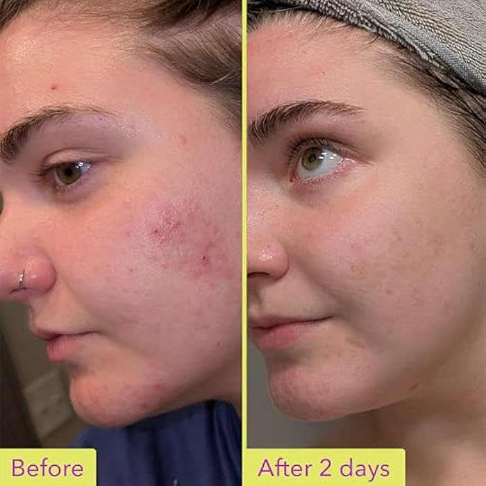 Good Molecules 10% Azelaic Acid Treatment for Face – Soothing Formula for Facial Redness & Uneven Tone – Brightens Dark Spots & Refines Texture – Vegan & Fragrance-Free Skincare (30ml / 1.01 fl oz.) - Image 3