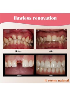 Ocean Resin Denture False Teeth, Teeth Crown Resin Denture For Patients With Oral Cavity Loss, Temporary Resistible Crown of Teeth with Different Sizes Oral Care (50 Pcs Front Teeth and 50 Pcs Back Teeth)  - Image 4