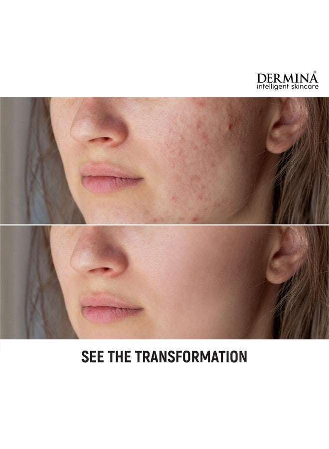 BLUEKITES Dermina Anti Acne Facewash 60gm( Pack of 3) - Image 3