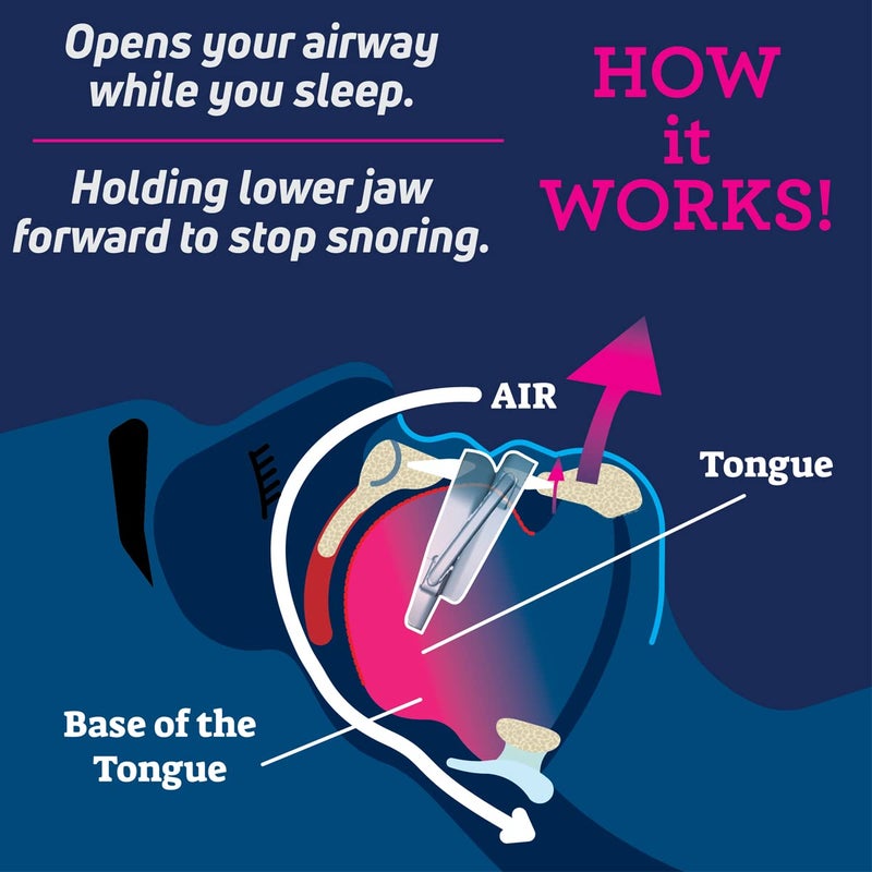 SmartGuard Anti Snore Device. New Customizable Snore Reducing Mouthpiece â€“ Reduce Snoring Aid for Men and Women â€“ Most Comfortable and Adjustable Oral Appliance - Holds Jaw Forward to Open Airway - Image 4