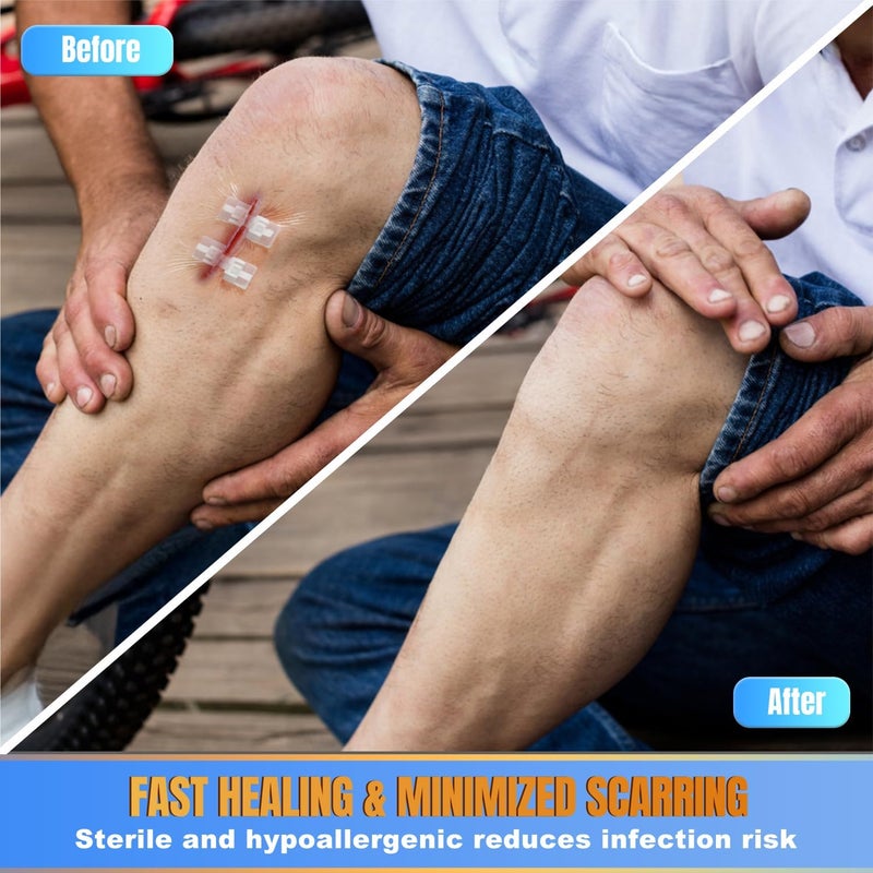 4 مجموعات من لاصقات الفراشة للعناية بالجروح جهاز إغلاق الجروح الطارئة إصلاح الجروح الجراحية بدون خياطة إغلاق سريع للجلد من الدرجة الطبية للاستخدام المنزلي في الهواء الطلق شرائط إغلاق الجروح بسحاب - Image 5