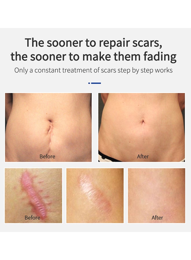 ام اس ال اي ام جل علاج الندبات ، كريم إزالة الندبات ، كريم إصلاح الندبات ، إزالة علامات تمدد الندبات ، تخفيف وإصلاح علامات حب الشباب (20 جرام) - Image 2