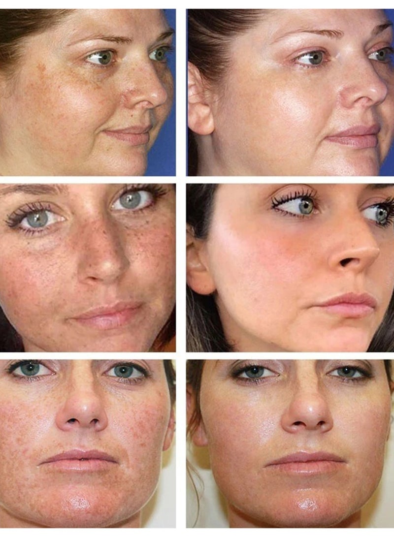 iBealee Dark Spot Remove, Mild Whitening Freckle Facial Cream, Pigmentation Sun Spots and Age Spots Treatment, Blemish Remover Lightening Cream, 20g  - Image 5