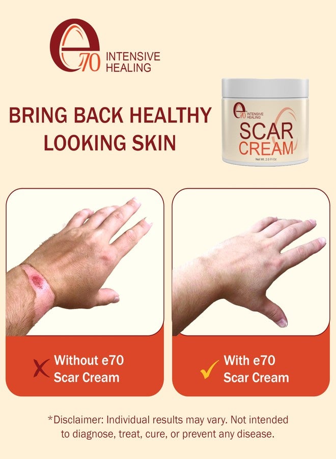 e70 Scar Cream Gel for Surgical Scars Fast Repair C-Section -2.0 Fl Oz , Stretch Marks, Keloids, Burns, Scar Away Cream for Old Scars. Vitamins Full - All Skin Types - Reduce Acne Spots and scar treatment - Image 4