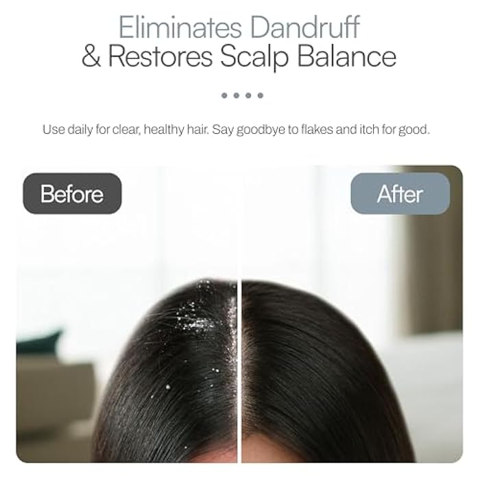 Foltene Anti Dandruff Shampoo for Men & Women – Dry Scalp Shampoo for Itchy & Oily Scalp – Dandruff Treatment with Piroctone Olamine & Salicylic Acid – Sulfate-Free formula – 6.76 fl oz - Image 5