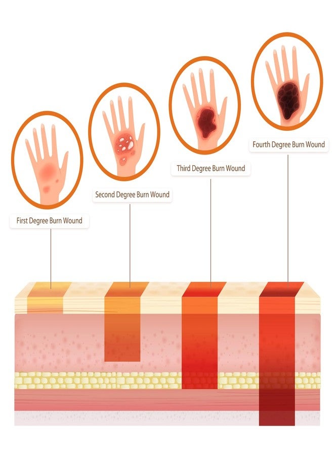 MedEduQuest Burn Wound Packing Trainer, Burn Moulages Kit, Adhesive Skin Burn Wound Trainer for Wound Care Training, Burn Wound Training Model - Image 5