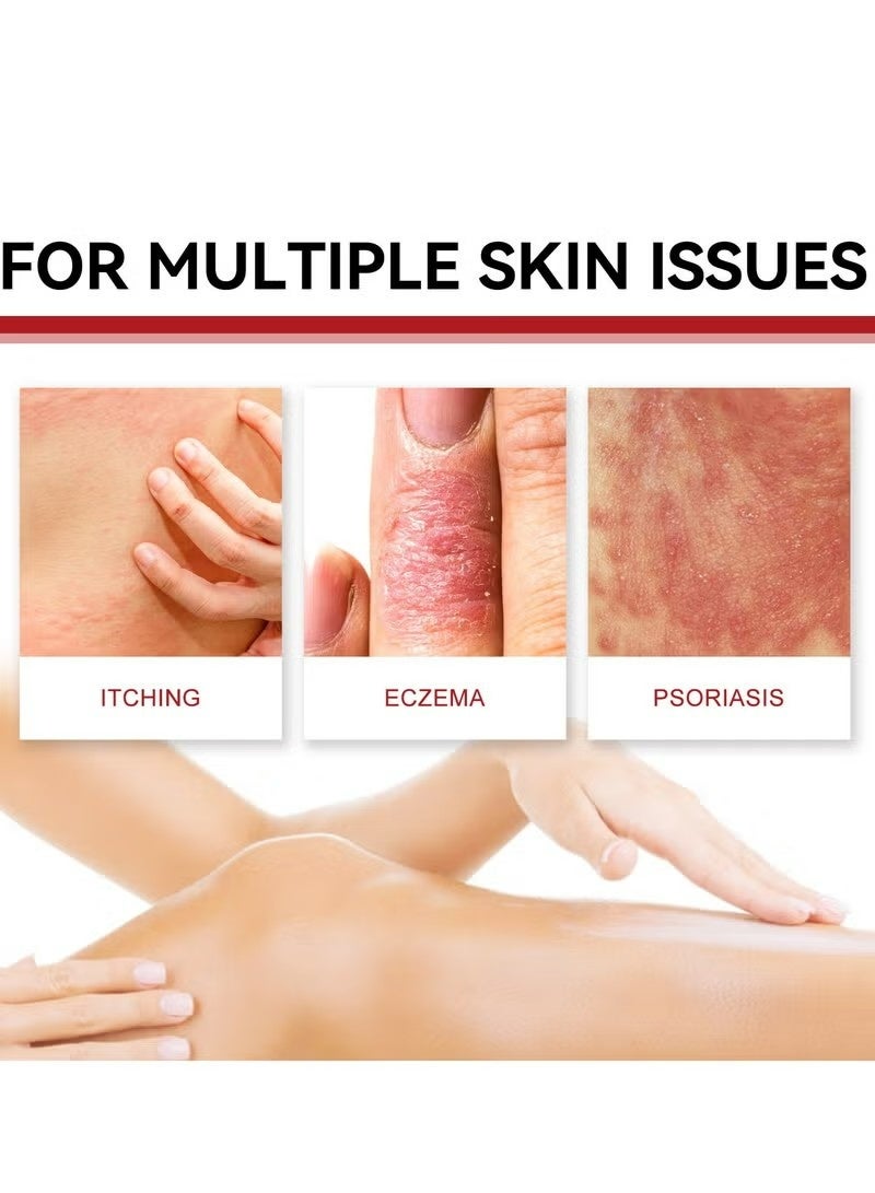 SOUTH MOON Antibacterial Cream,Psoriasis Cream，Natural Chinese Herbal Eczema Psoriasis Creams Dermatitis and Eczema Pruritus Psoriasis Ointment，Psoriasis Creams - Psoriasis Treatment, Antibacterial Cream,for Body Itching 30g - Image 3