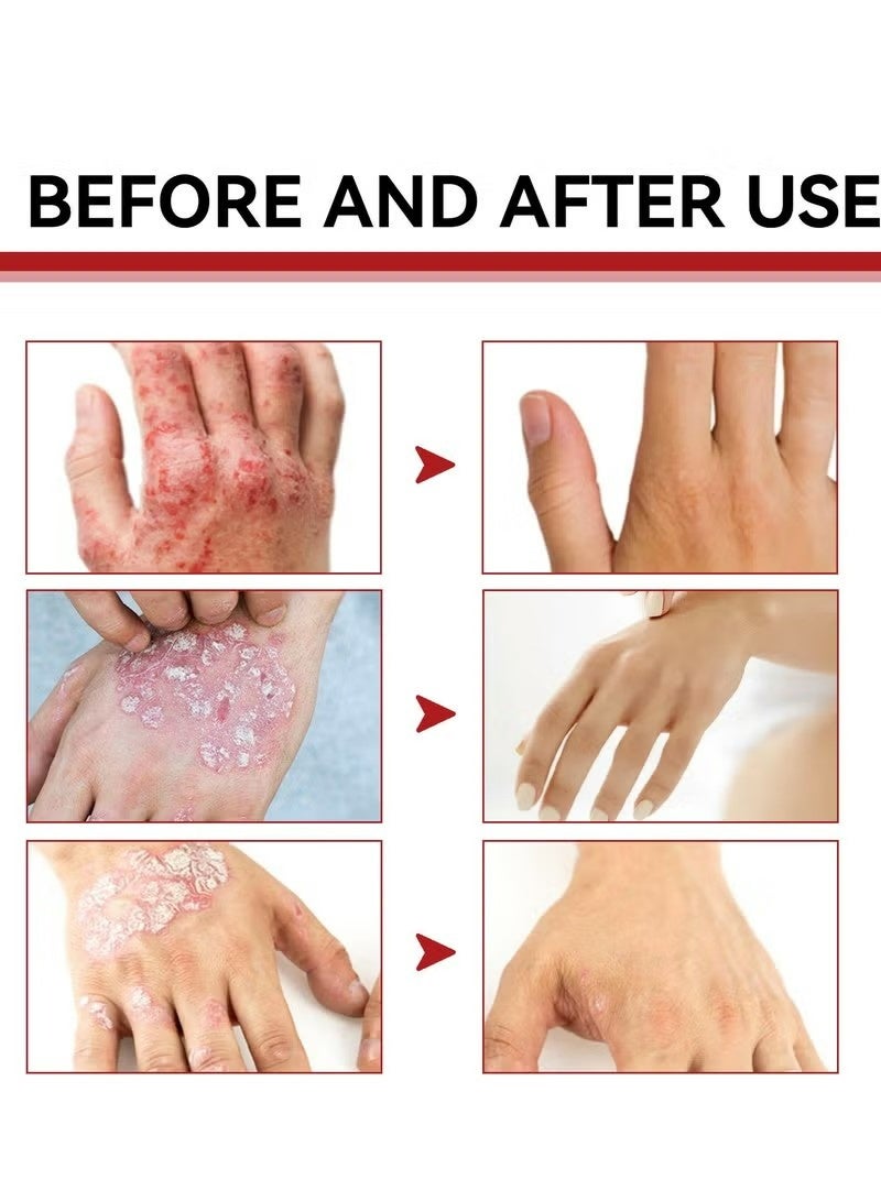 SOUTH MOON Antibacterial Cream,Psoriasis Cream，Natural Chinese Herbal Eczema Psoriasis Creams Dermatitis and Eczema Pruritus Psoriasis Ointment，Psoriasis Creams - Psoriasis Treatment, Antibacterial Cream,for Body Itching 30g - Image 4