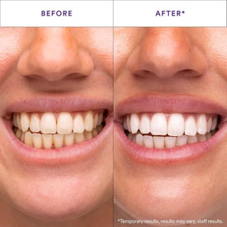 Hismile V34 Whitening Strips - Teeth Whitening Strips with Colour Correction Technology - view 2