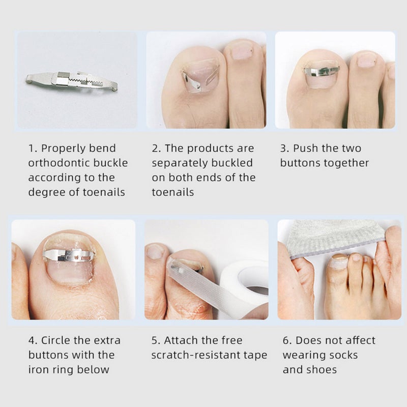 Ingrown Toenail Tools Kit for Ingrown Toenail Removal Correction Toe Nail Corrector & Tape Toenail Treatment Foot Care Tool - Image 4