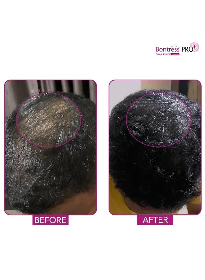 Bontress PRO+ Scalp Serum Fortified with Redensyl, Anagain, Capixyl,Procapil | Hair Serum for Hair Growth & Hair Fall 30ml - Image 4