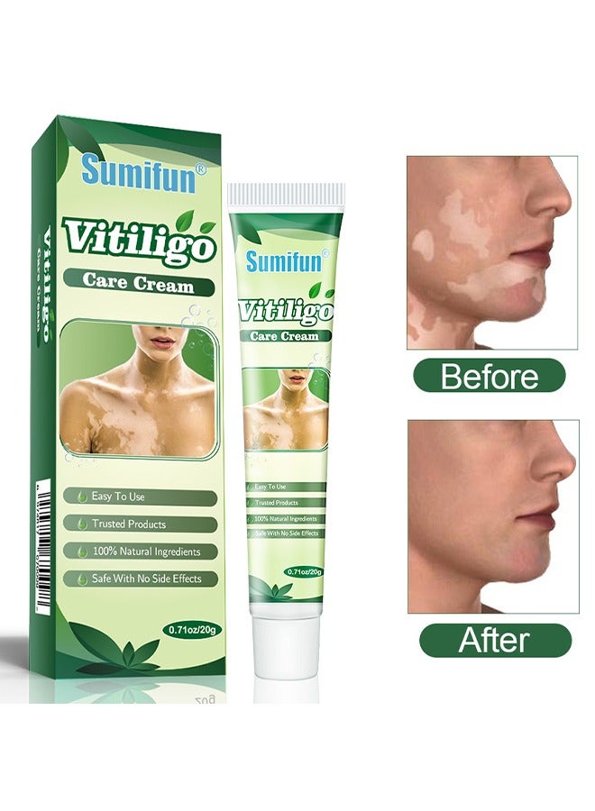 سوميفون كريم الرعاية البهاق ، والحد من طلوان الجلد ، وتنظيم تصبغ الجلد ، كريم إزالة القشرة 20G - Image 1