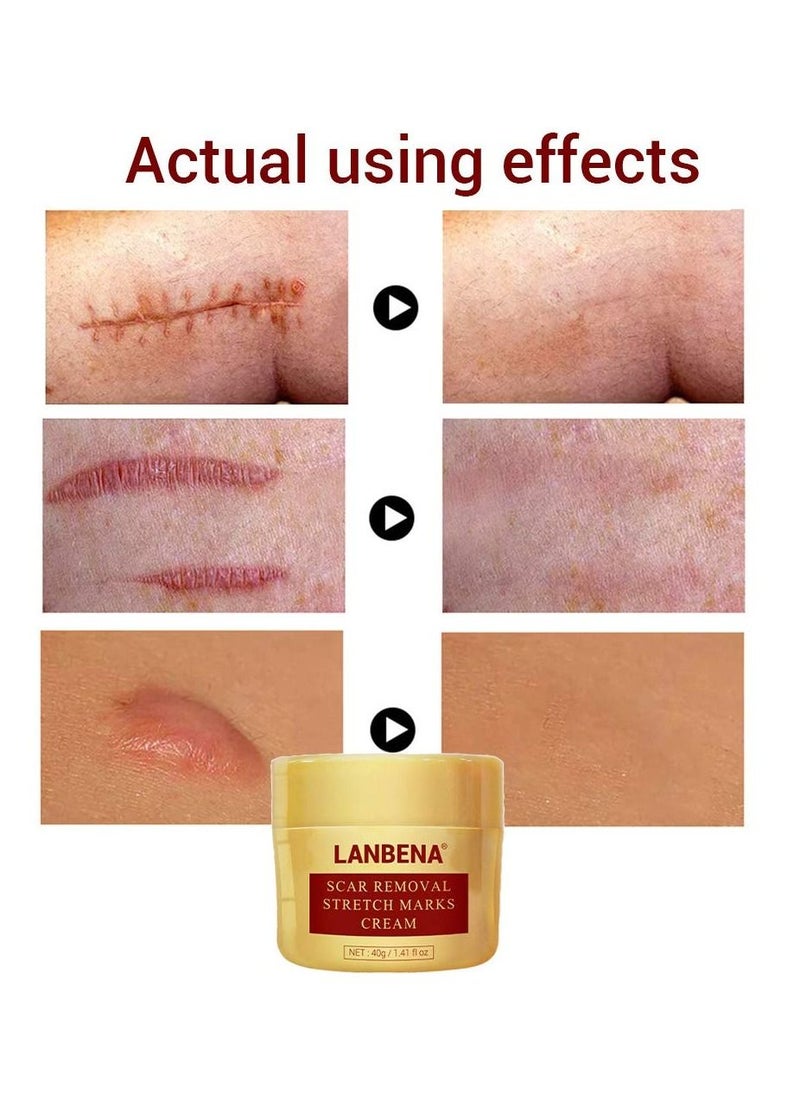LANBENA - LANBENA Scar Removal Stretch Marks Cream Fade Acne and Pocks Soften Scars Resulting from Surgery, Injury, Burns and Scar Skin Repair Gel for Face & Body 40 g - Image 1