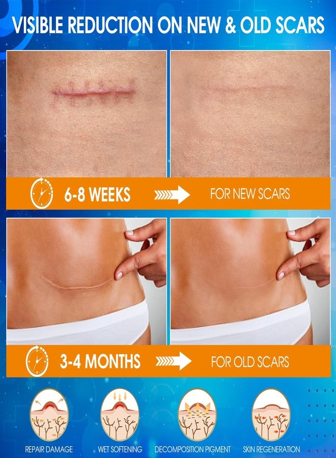 OUJEALEE Silicone Scar Tape, Medical Grade Silicone Scar Sheets for Surgical Scars - Image 3