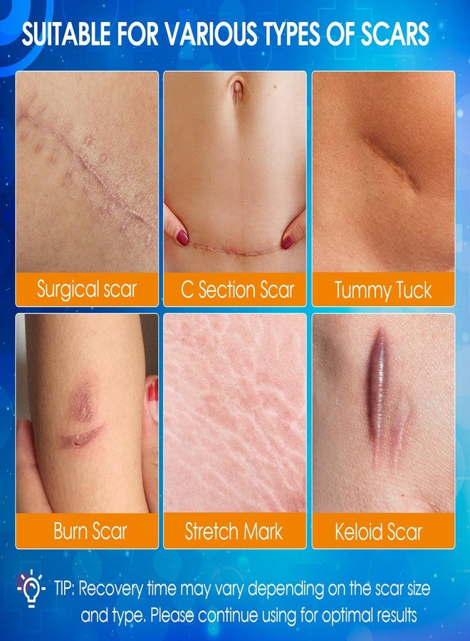 OUJEALEE Silicone Scar Tape, Medical Grade Silicone Scar Sheets for Surgical Scars - Image 4