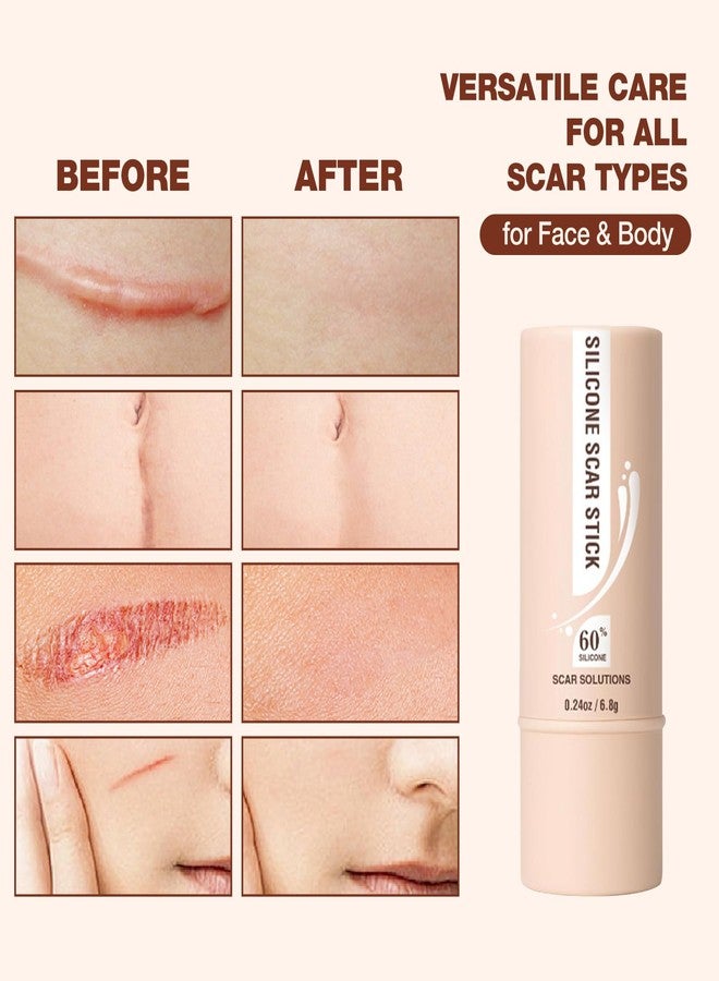 Wismee 2pcs Silicone Scar Stick, Made of 60% Silicone,Reduces the Appearance of Scars,Gentle on All Skin Types - Image 4