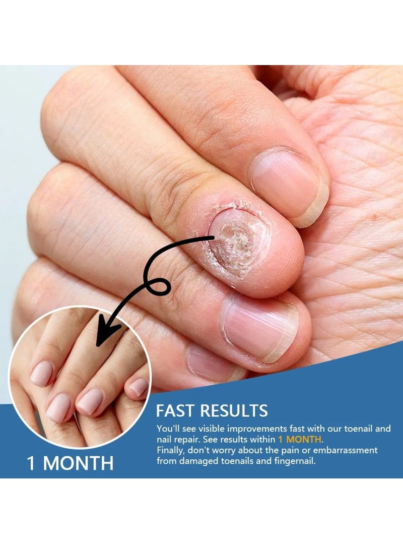 Sumifun بخاخ تخفيف فطريات الأظافر لتجديد الأظافر اليدوية والقدمية، إصلاح مضاد للفطريات، تنعيم وترطيب الأظافر، تغذية واستعادة الأظافر الصحية، بخاخ علاج فطريات الأظافر 30 مل - Image 2
