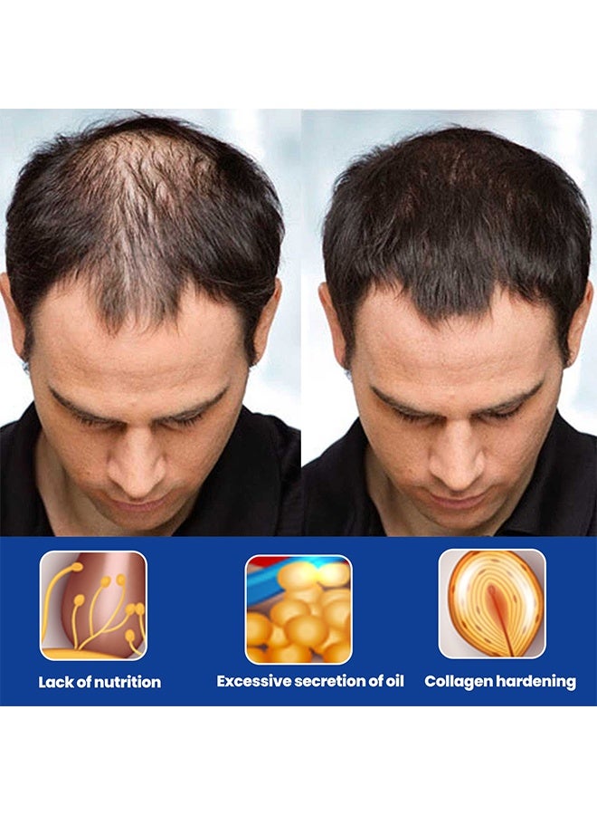 إيست مون رغوة مينوكسيديل 5٪ لنمو الشعر للرجال، لمحاربة تساقط الشعر، وترقق الشعر، وتراجع خط الشعر، يعزز لحية وشعر أكثر كثافة، يساعد على منع الترقق، ويكثف الشعر ليصبح أكثر امتلاءً، غير دهنية - 60 مل - Image 4